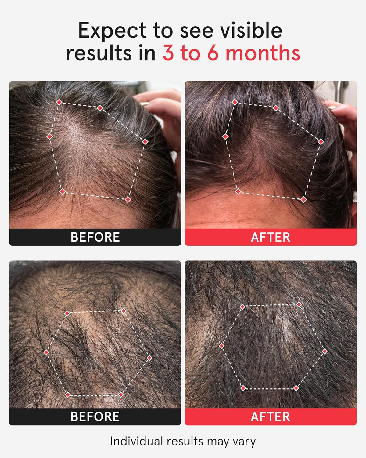 iRestore Professional Laser Red Light Therapy for Hair Growth System – FDA Cleared Hair Loss, Hair Thinning & Alopecia Treatment for Men & Women – 282 Lasers & LEDs - Image 2