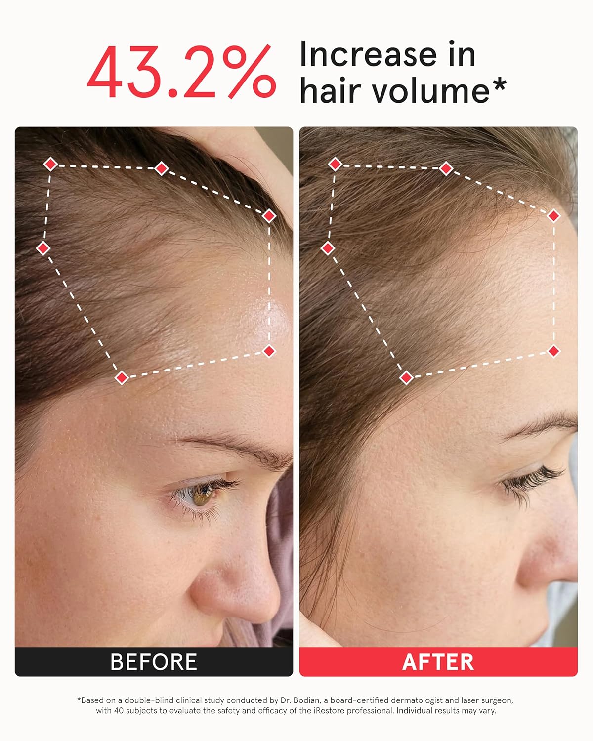 iRestore Professional Laser Red Light Therapy for Hair Growth System – FDA Cleared Hair Loss, Hair Thinning & Alopecia Treatment for Men & Women – 282 Lasers & LEDs - Image 4